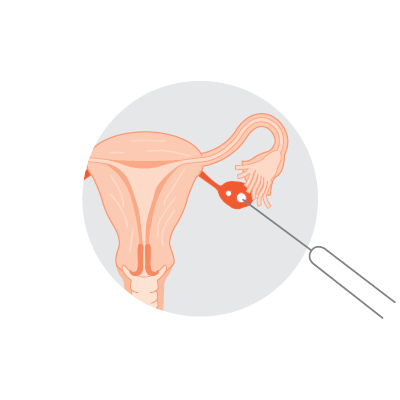 Egg collection Mature egg/s are collected from the follicle using a needle guided by ultrasound.