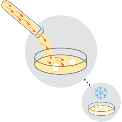 Egg and sperm combined The eggs are combined with sperm from a partner or donor, or frozen (cryopreservation) for later use.