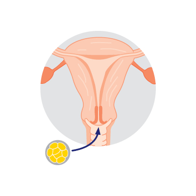 Embryo transfer A syringe and tube is used to implant embryos into your body (or a surrogate). This will usually happen after cancer treatment.
