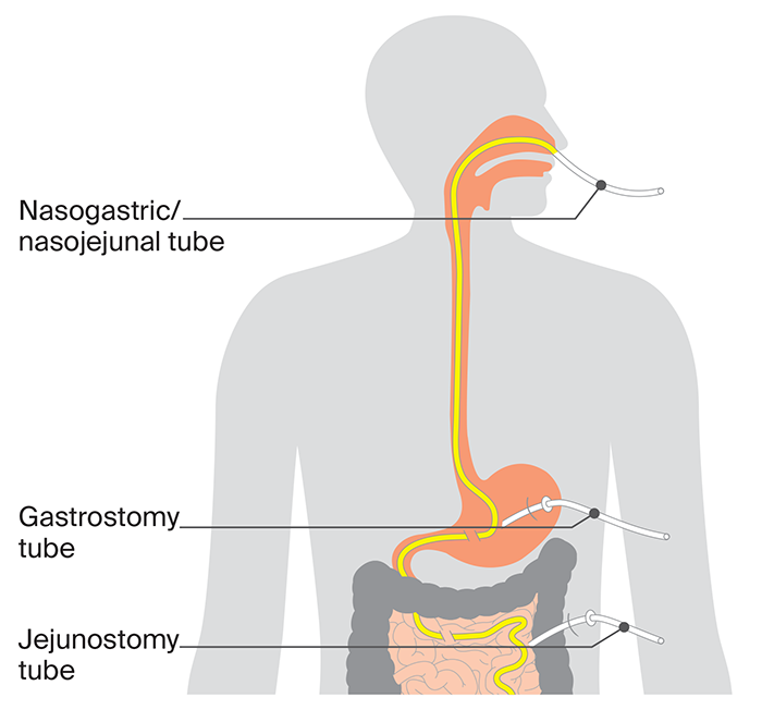 Image of how a feeding tube works