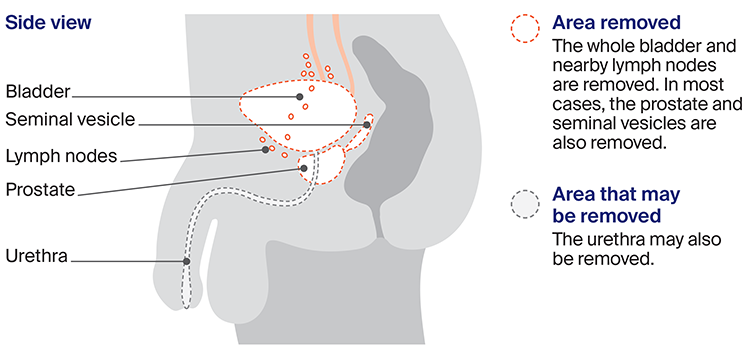Illustration showing cystectomy in males